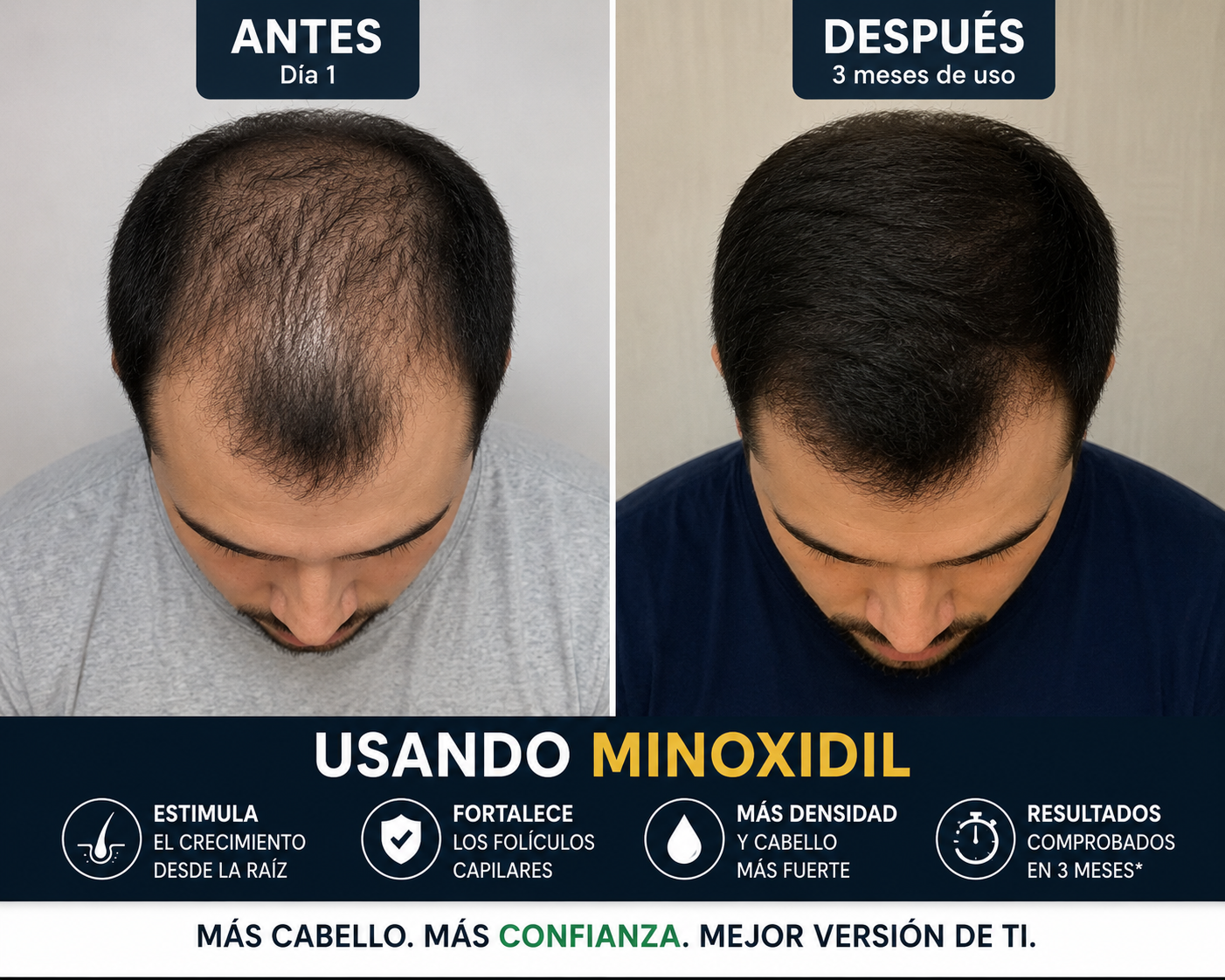 Minoxidil topical 5%